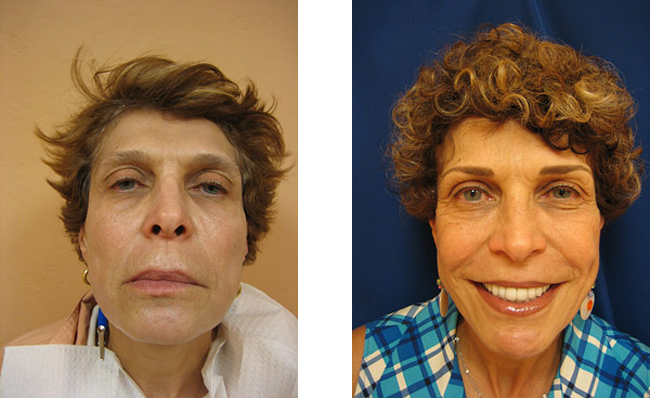 Permanent Makeup Before After. full face permanent makeup